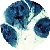 유레아플라즈마 (Ureaplasma Urealytium)
